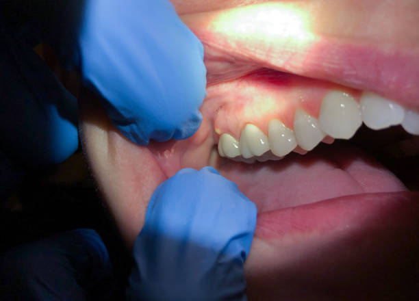 Best Emergency Treatment for Dental Infections or Abscesses in Chelsea, AL